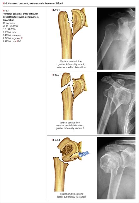 A humerus fracture is a break of the humerus bone in the upper arm. . Right humeral neck fracture icd 10